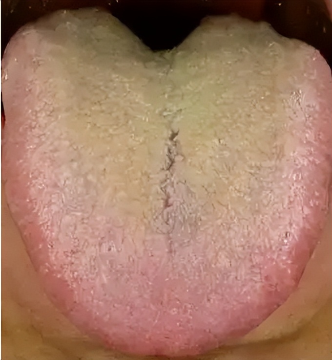 Kidney Deficiency Random Supplement Warning This Tongue Sign